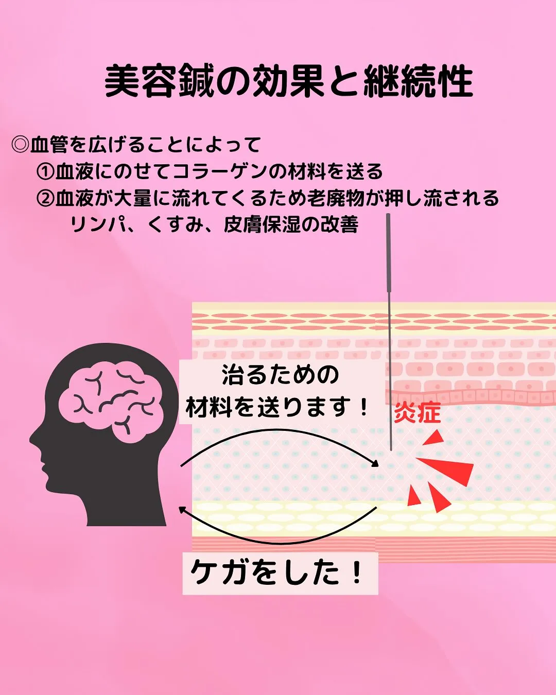 【✨美容鍼って本当に効くの？🪡】
