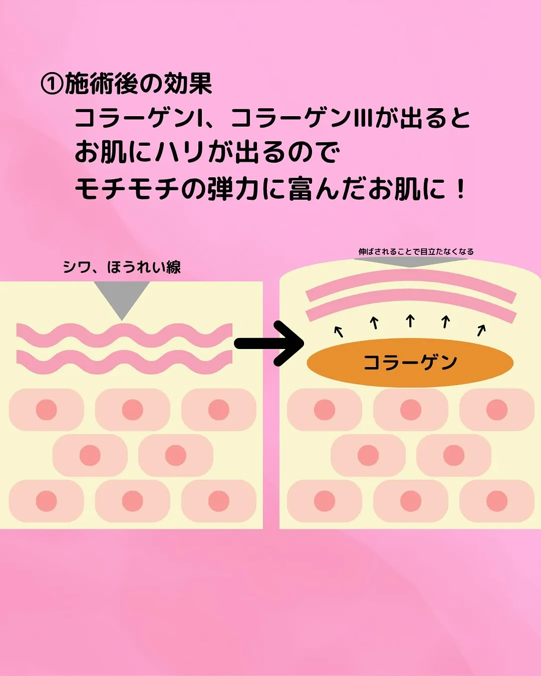 【✨美容鍼って本当に効くの？🪡】