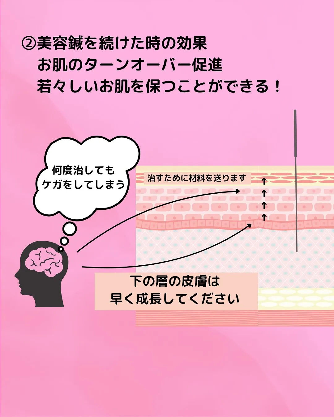 【✨美容鍼って本当に効くの？🪡】