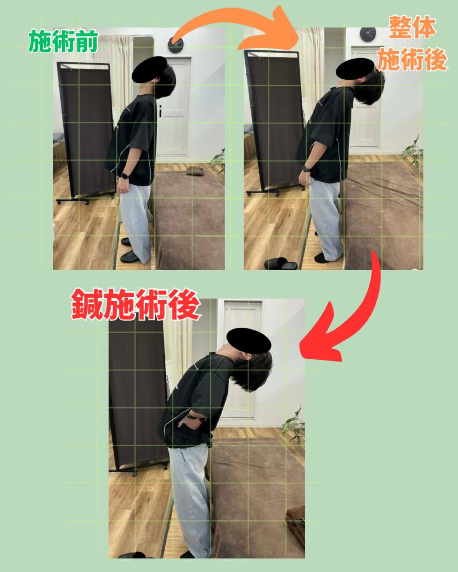 🏥【脊椎分離症による腰痛でお悩みの方へ】
