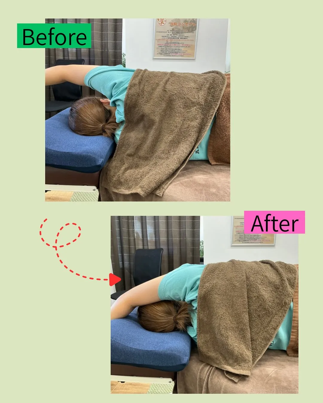 🌿【肩こりには鍼灸が効果的】🌿