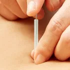 鍼灸