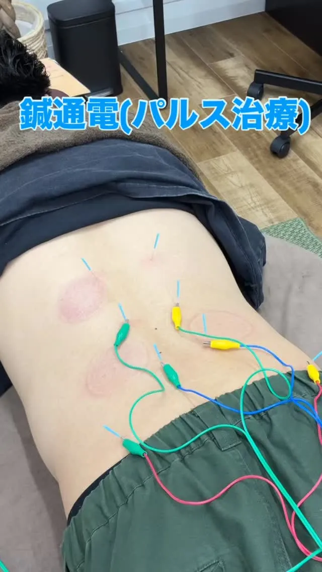 【鍼通電（パルス治療）とは？】