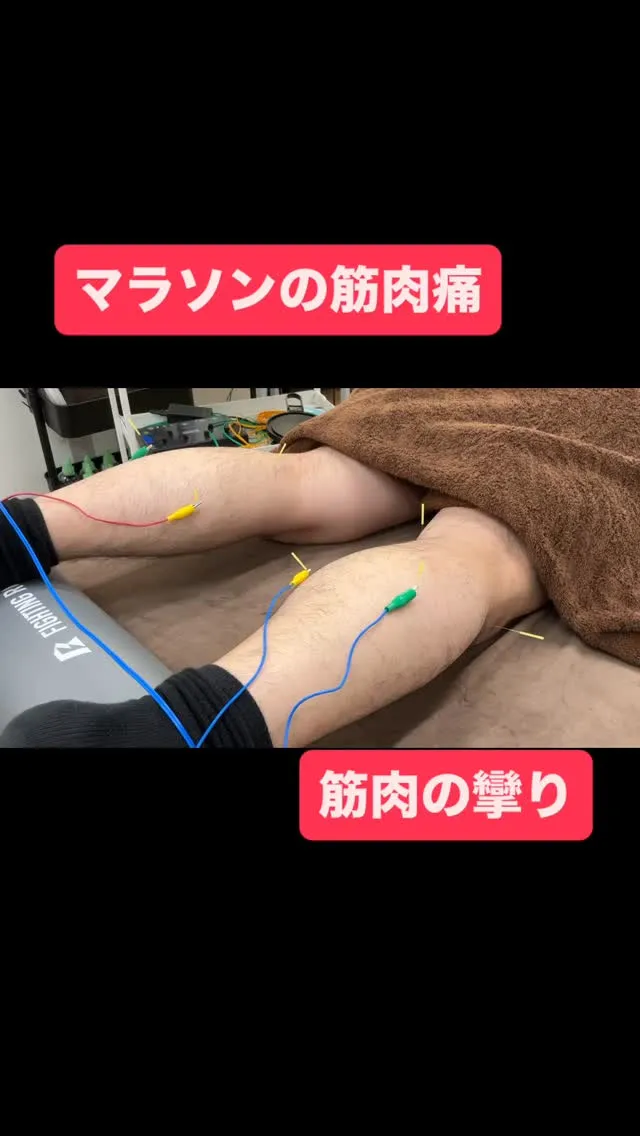 【筋肉痛に効果的💡鍼＋電気のパルス治療⚡】